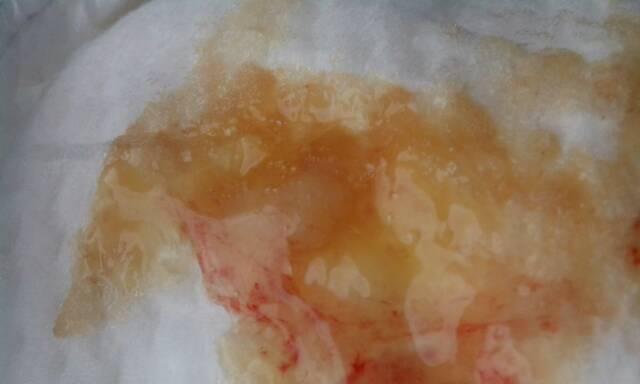 尿中带血的常见原因与应对措施，了解血尿背后的健康信号