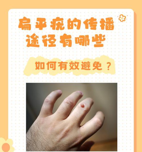 常见传染病预防指南:传播途径与防控措施全解析 常见传染病预防指南:传播途径与防控措施全解析