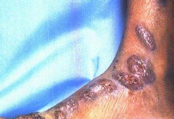 脓皮症症状、成因与防治指南 脓皮症症状、成因与防治指南