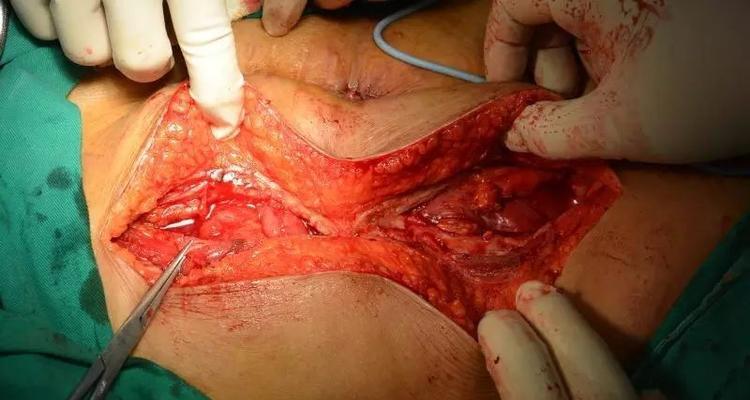 狗肠梗阻手术恢复关键因素与护理指南