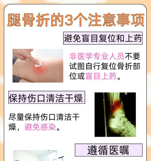 大腿骨折康复全解析:恢复阶段与注意事项 大腿骨折康复全解析:恢复阶段与注意事项