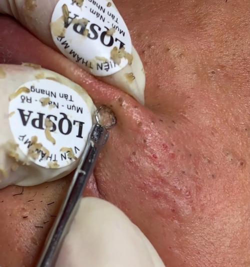 猫咪下巴黑头处理方法与预防措施详解