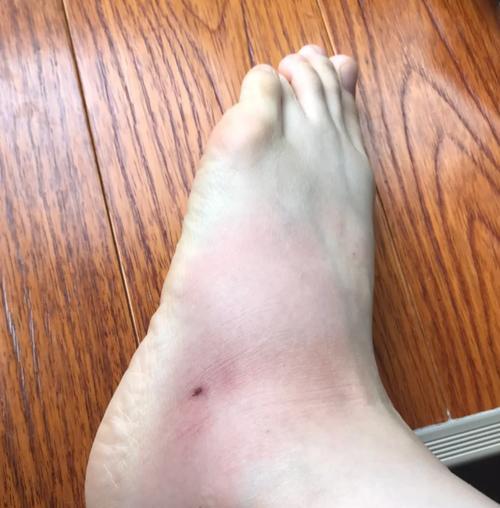 皮肤擦伤发炎怎么办?正确处理方法与护理指南 皮肤擦伤发炎怎么办?正确处理方法与护理指南