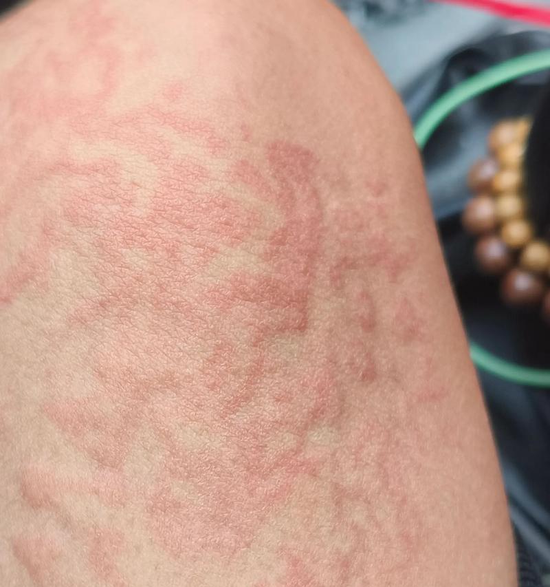 疫苗接种后过敏反应原因分析及预防处理指南 疫苗接种后过敏反应原因分析及预防处理指南