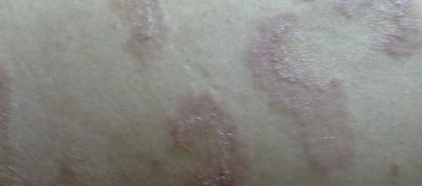 英斗皮肤病全面解析:病因症状与有效治疗方法指南 英斗皮肤病全面解析:病因症状与有效治疗方法指南