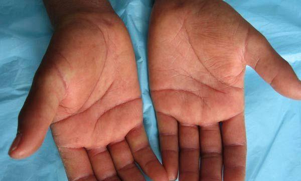 英斗皮肤病全面解析:病因症状与有效治疗方法指南 英斗皮肤病全面解析:病因症状与有效治疗方法指南