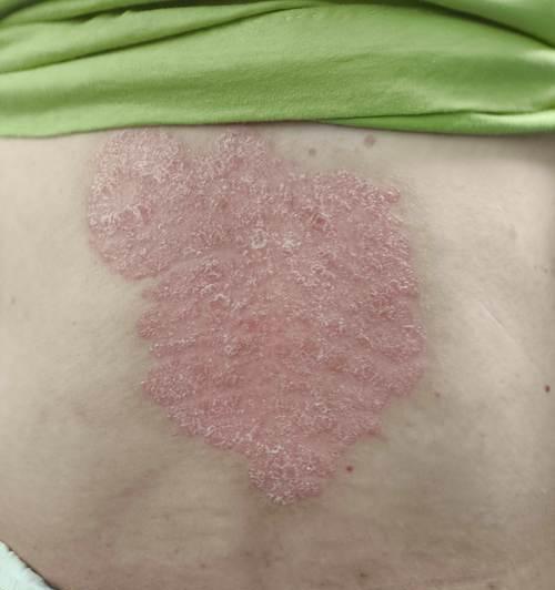 常见的传染性皮肤病有哪些？（了解传染性皮肤病，预防传播才能更有效）