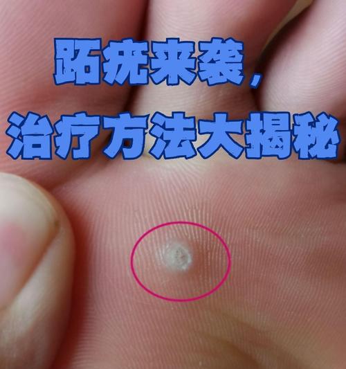 常见的传染性皮肤病有哪些？（了解传染性皮肤病，预防传播才能更有效）