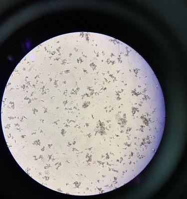 膀胱结晶形成原因、症状表现与有效治疗方法全解析 膀胱结晶形成原因、症状表现与有效治疗方法全解析